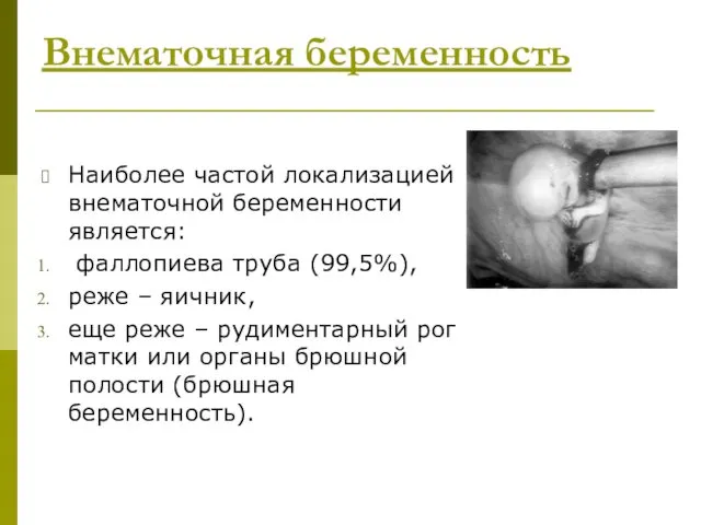 Внематочная беременность Наиболее частой локализацией внематочной беременности является: фаллопиева труба (99,5%),