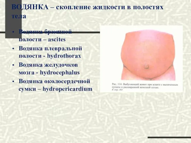 ВОДЯНКА – скопление жидкости в полостях тела Водянка брюшной полости –