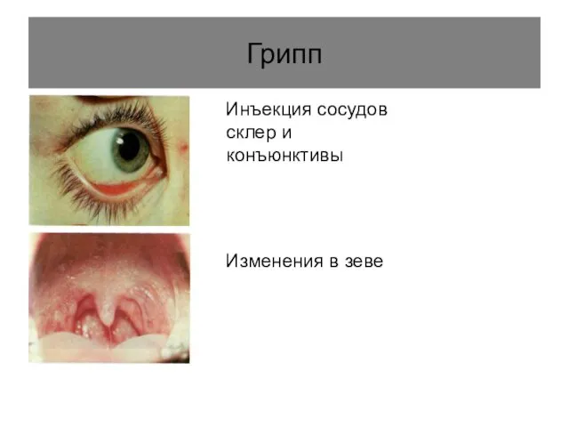Грипп Инъекция сосудов склер и конъюнктивы Изменения в зеве