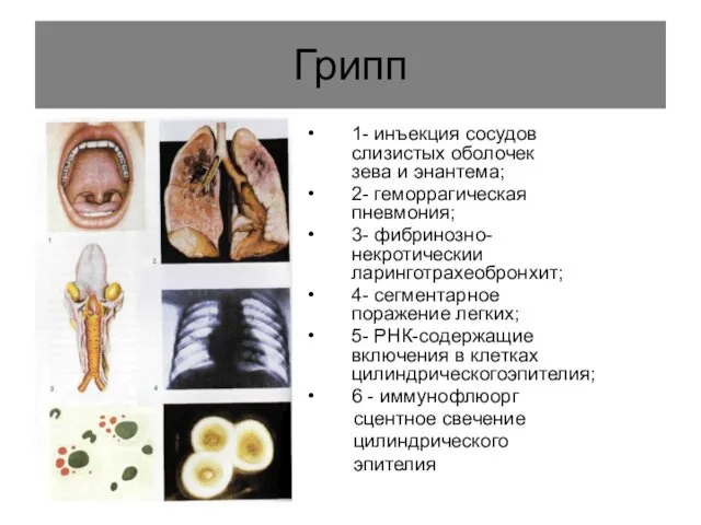 Грипп 1- инъекция сосудов слизистых оболочек зева и энантема; 2- геморрагическая