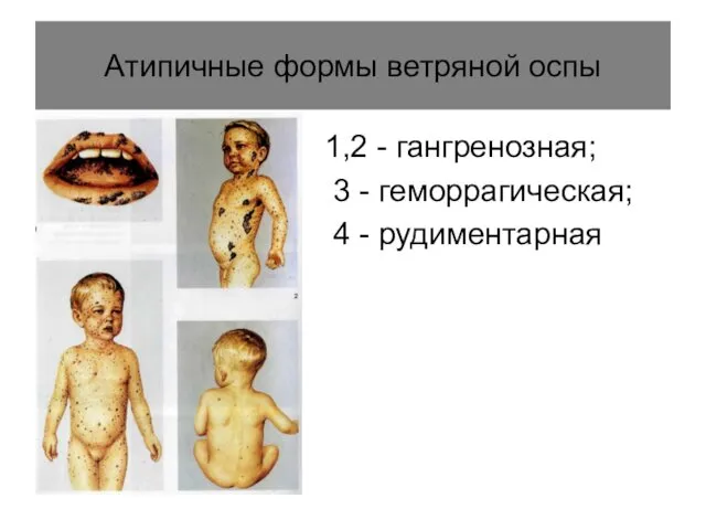 Атипичные формы ветряной оспы 1,2 - гангренозная; 3 - геморрагическая; 4 - рудиментарная