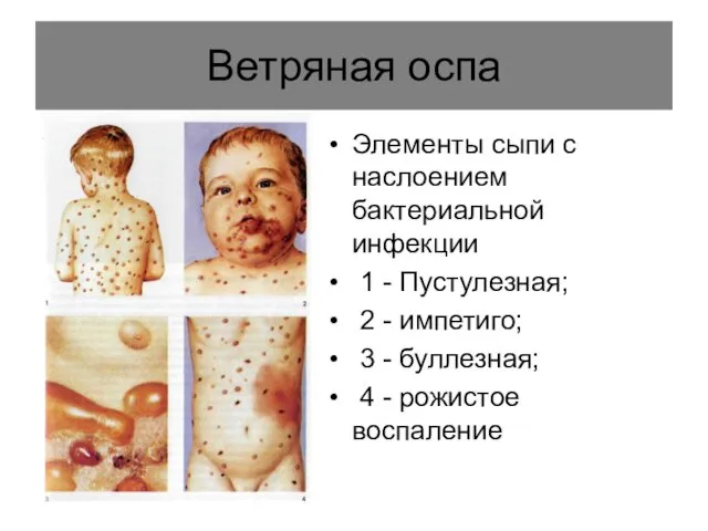 Ветряная оспа Элементы сыпи с наслоением бактериальной инфекции 1 - Пустулезная;