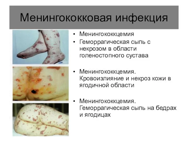 Менингококковая инфекция Менингококкцемия Геморрагическая сыпь с некрозом в области голеностопного сустава