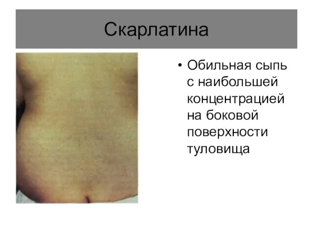 Скарлатина Обильная сыпь с наибольшей концентрацией на боковой поверхности туловища