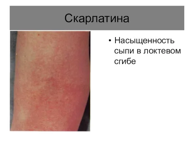 Скарлатина Насыщенность сыпи в локтевом сгибе