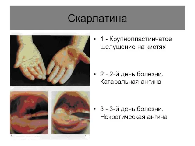 Скарлатина 1 - Крупнопластинчатое шелушение на кистях 2 - 2-й день