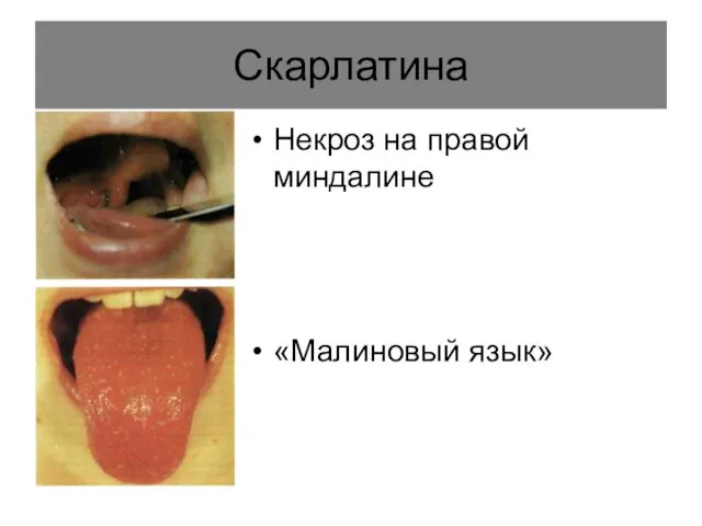 Скарлатина Некроз на правой миндалине «Малиновый язык»