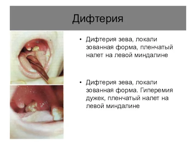 Дифтерия Дифтерия зева, локали­зованная форма, пленчатый налет на левой миндалине Дифтерия