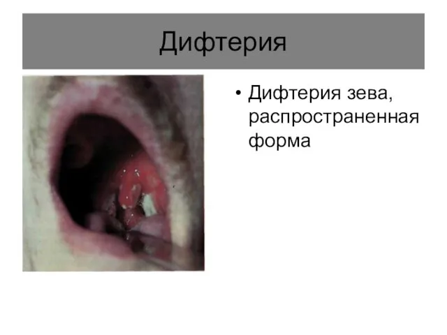 Дифтерия Дифтерия зева, распространенная форма