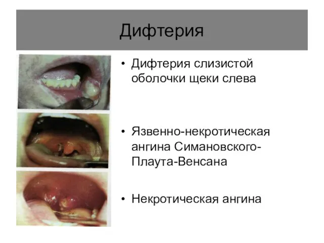 Дифтерия Дифтерия слизистой оболочки щеки слева Язвенно-некротическая ангина Симановского-Плаута-Венсана Некротическая ангина