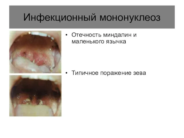 Инфекционный мононуклеоз Отечность миндалин и маленького язычка Типичное поражение зева