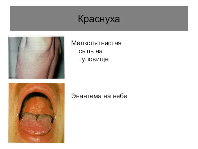 Краснуха Мелко­пятнистая сыпь на туловище Энантема на небе