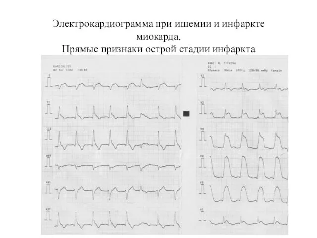 Электрокардиограмма при ишемии и инфаркте миокарда. Прямые признаки острой стадии инфаркта миокарда передней стенки