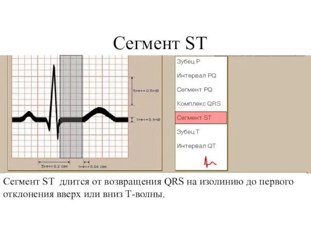 Сегмент ST Сегмент ST длится от возвращения QRS на изолинию до