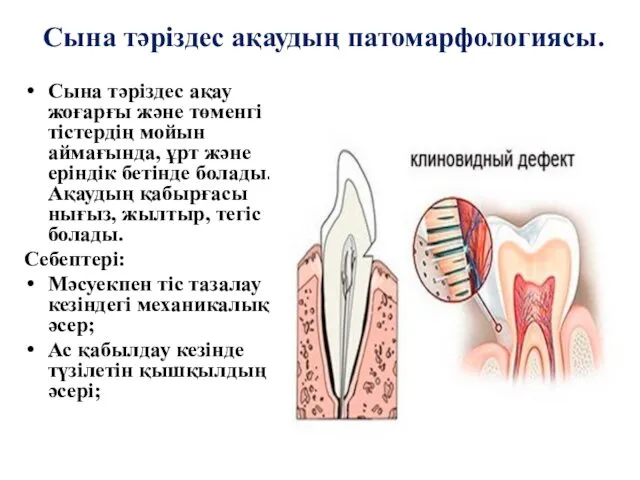 Сына тәріздес ақаудың патомарфологиясы. Сына тәріздес ақау жоғарғы және төменгі тістердің