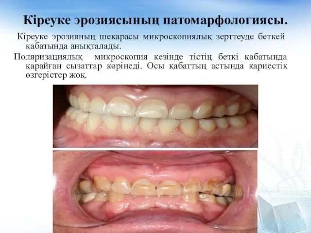 Кіреуке эрозиясының патомарфологиясы. Кіреуке эрозияның шекарасы микроскопиялық зерттеуде беткей қабатында анықталады.