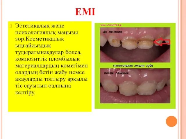 ЕМІ Эстетикалық және психологиялық маңызы зор.Косметикалық ыңғайсыздық тудыратынақаулар болса,композиттік пломбылық материалдардың