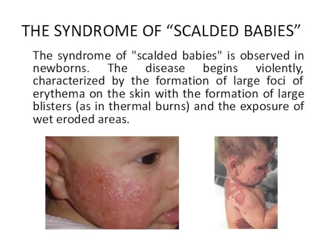 THE SYNDROME OF “SCALDED BABIES” The syndrome of "scalded babies" is