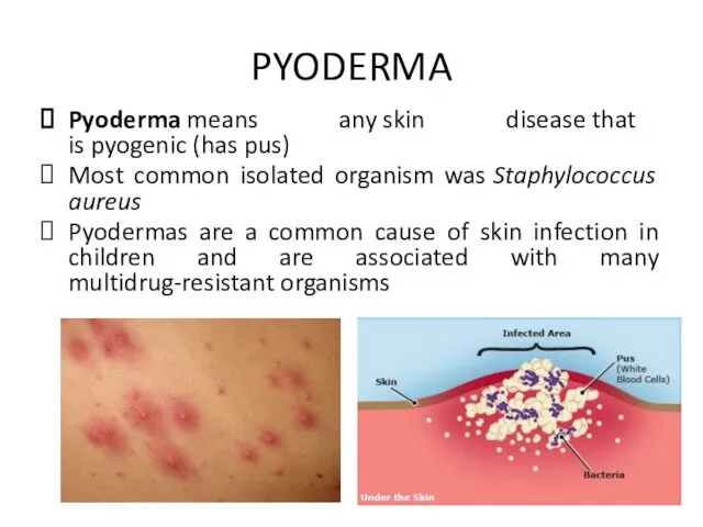 PYODERMA Pyoderma means any skin disease that is pyogenic (has pus)