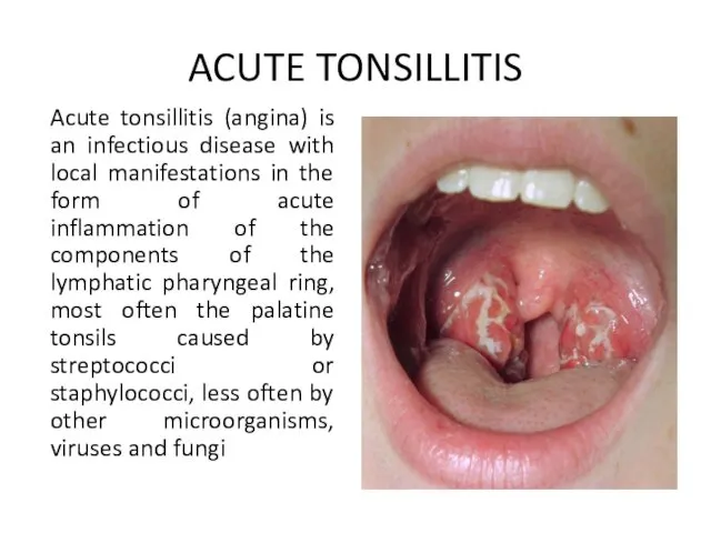 ACUTE TONSILLITIS Acute tonsillitis (angina) is an infectious disease with local