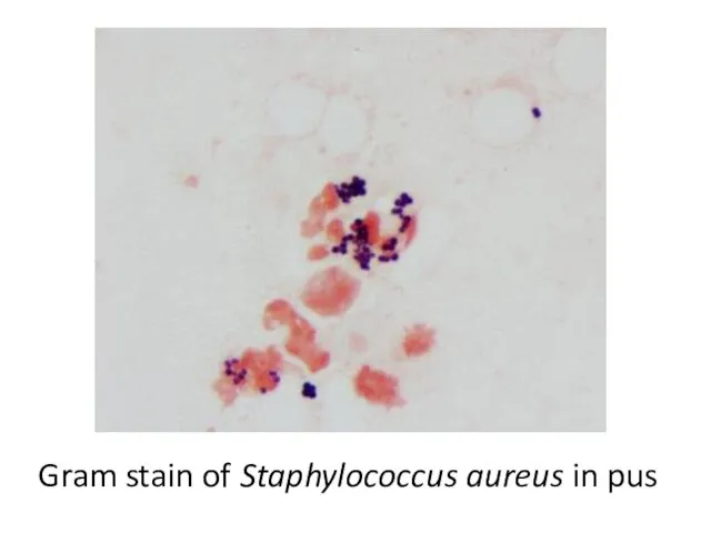 Gram stain of Staphylococcus aureus in pus