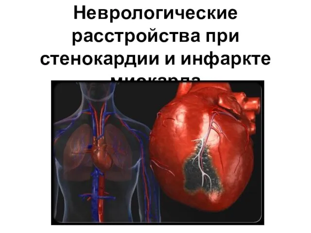 Неврологические расстройства при стенокардии и инфаркте миокарда