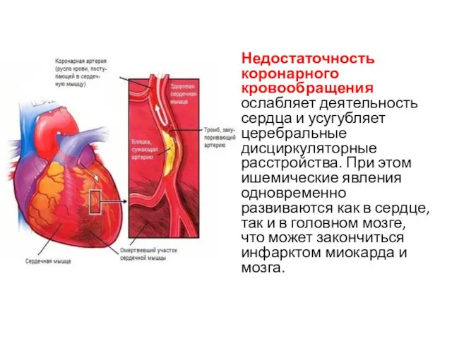 Недостаточность коронарного кровообращения ослабляет деятельность сердца и усугубляет церебральные дисциркуляторные расстройства.