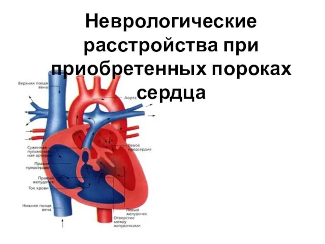 Неврологические расстройства при приобретенных пороках сердца
