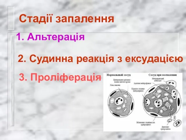 Стадії запалення 3. Проліферація 1. Альтерація 2. Судинна реакція з ексудацією