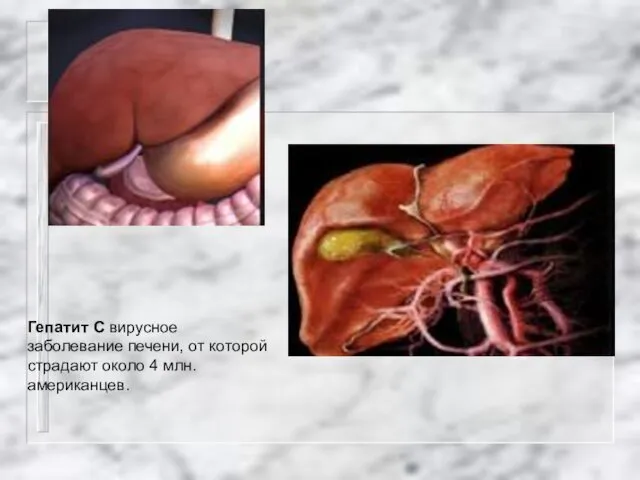 Гепатит С вирусное заболевание печени, от которой страдают около 4 млн. американцев.