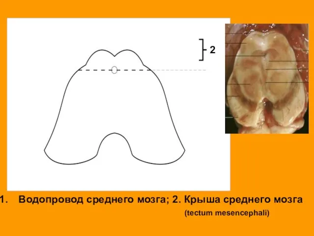 Водопровод среднего мозга; 2. Крыша среднего мозга (tectum mesencephali) 2