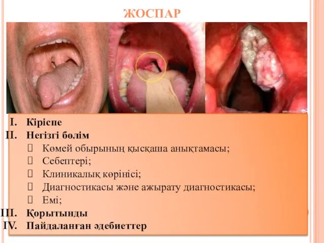 ЖОСПАР Кіріспе Негізгі бөлім Көмей обырының қысқаша анықтамасы; Себептері; Клиникалық көрінісі;