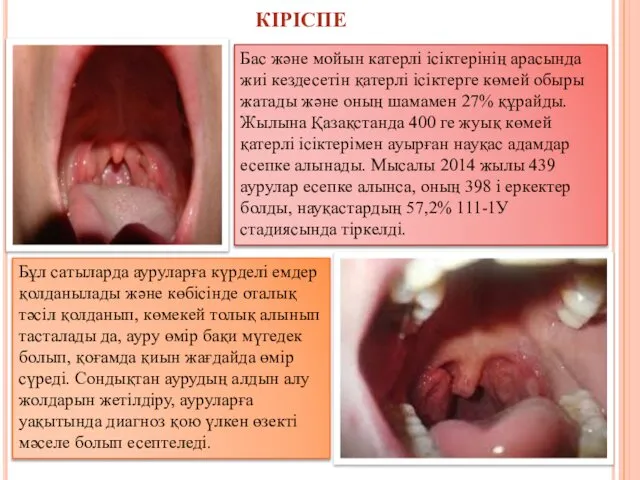 Бас және мойын катерлі ісіктерінің арасында жиі кездесетін қатерлі ісіктерге көмей