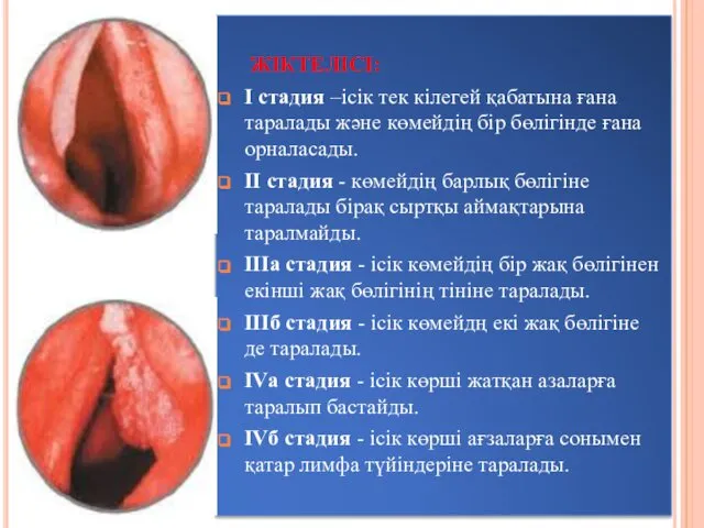 ЖІКТЕЛІСІ: I стадия –ісік тек кілегей қабатына ғана таралады және көмейдің