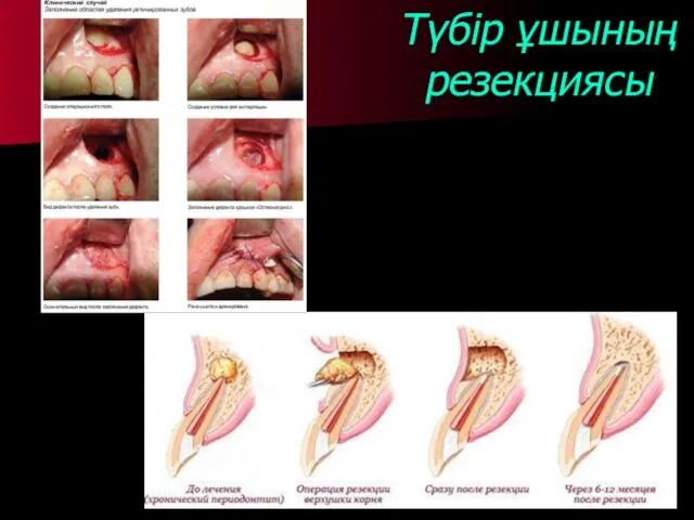 Түбір ұшының резекциясы