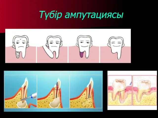 Түбір ампутациясы