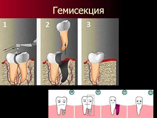 Гемисекция