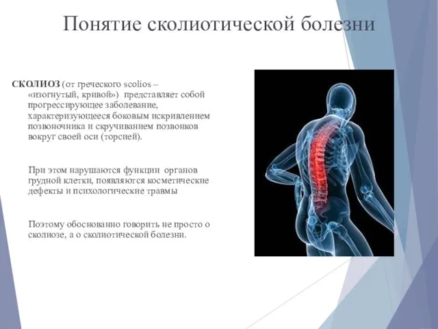 Понятие сколиотической болезни СКОЛИОЗ (от греческого scolios – «изогнутый, кривой») представляет