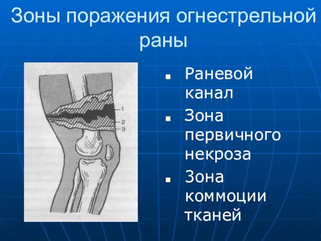 Зоны поражения огнестрельной раны Раневой канал Зона первичного некроза 3она коммоции тканей