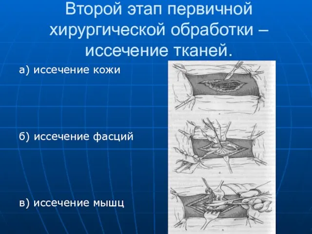 Второй этап первичной хирургической обработки – иссечение тканей. а) иссечение кожи