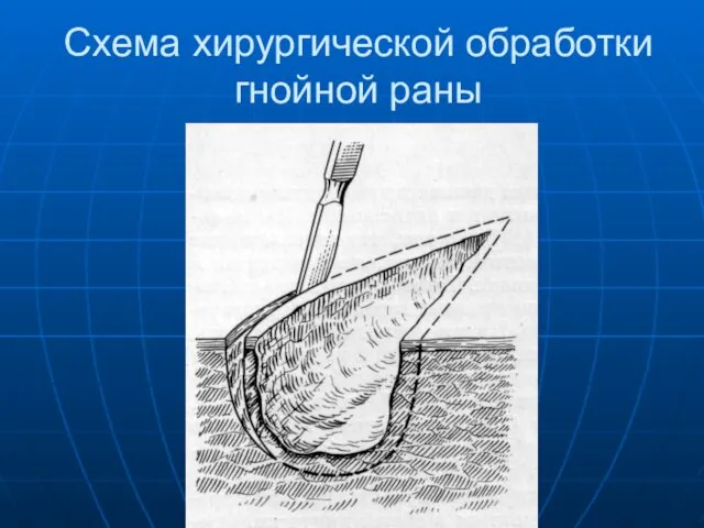 Схема хирургической обработки гнойной раны