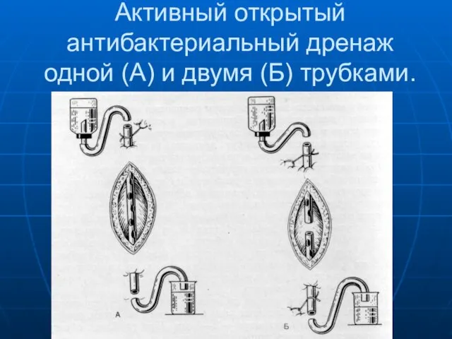 Активный открытый антибактериальный дренаж одной (А) и двумя (Б) трубками.