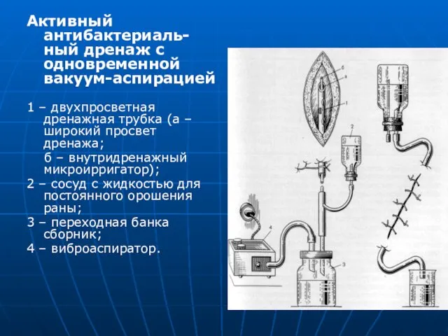 Активный антибактериаль-ный дренаж с одновременной вакуум-аспирацией 1 – двухпросветная дренажная трубка