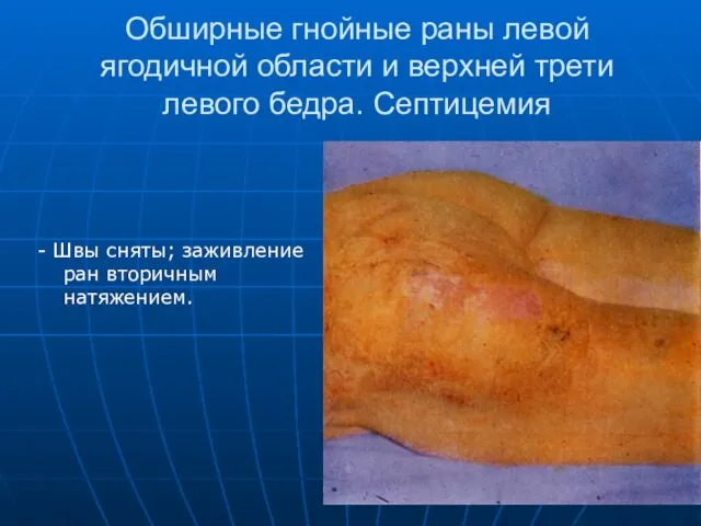 Обширные гнойные раны левой ягодичной области и верхней трети левого бедра.
