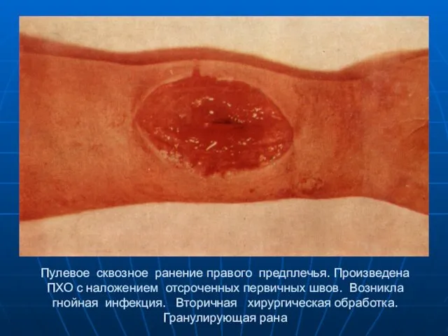 Пулевое сквозное ранение правого предплечья. Произведена ПХО с наложением отсроченных первичных