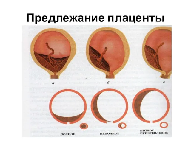 Предлежание плаценты