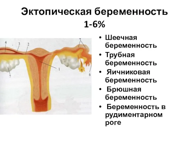 Эктопическая беременность 1-6% Шеечная беременность Трубная беременность Яичниковая беременность Брюшная беременность Беременность в рудиментарном роге