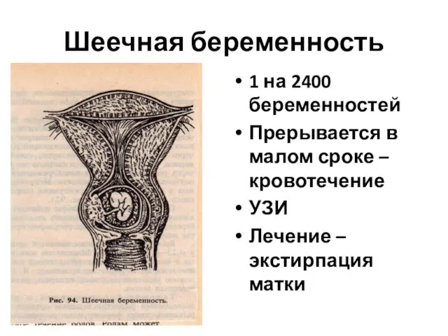 Шеечная беременность 1 на 2400 беременностей Прерывается в малом сроке –кровотечение УЗИ Лечение – экстирпация матки