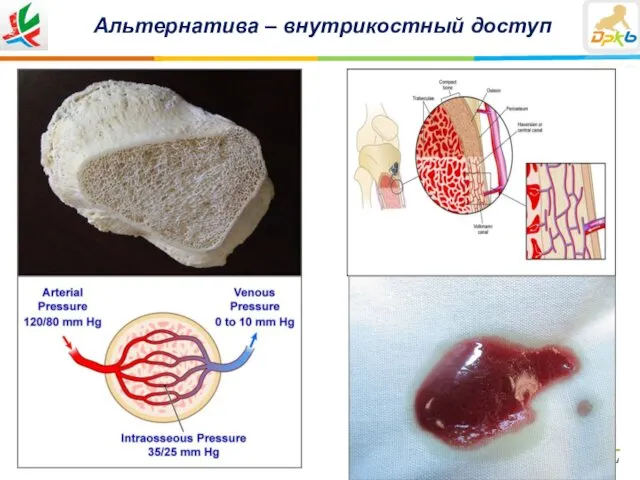 Альтернатива – внутрикостный доступ ДРКБ МЗ РТ | www.drkbmzrt.ru