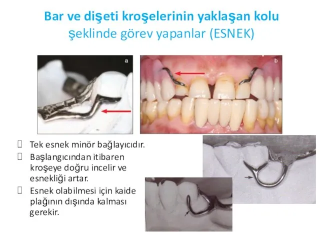 Bar ve dişeti kroşelerinin yaklaşan kolu şeklinde görev yapanlar (ESNEK) Tek